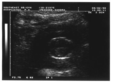 ultrasound